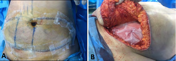 Figure 4: A, B anterior and lateral view with marking. C, D, umbilicus and skin incision.