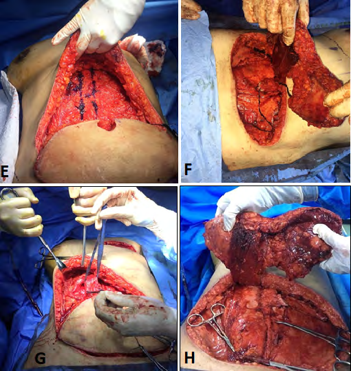 Figure 5: A, mastectomy site preparation, B, tunnel creation.