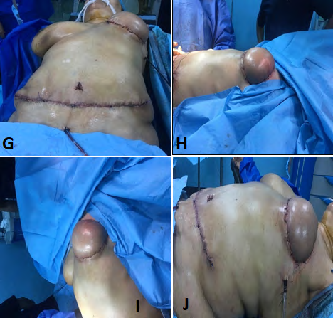 Figure 8: A, B, C, 3 views for patient with left mastectomy since 2 years, D, E, on table result.