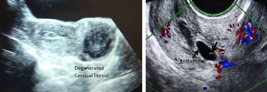 Figure 1: Ultrasonography image of a multiparous woman who presented with torrential and intractable bleeding in shock, showing distended cervix.