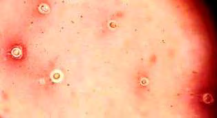 Figure 1: Indian ink microscopy of CSF.