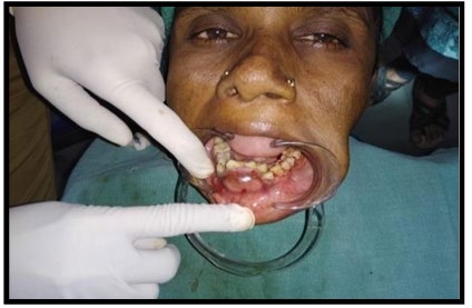 Figure 1: Intra Oral Swelling.