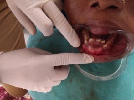 Figure 2: Swelling Involved Along the Lower Anterior Teeth Region.