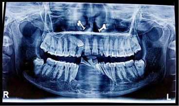 Figure 3: Provisional diagnosis was ameloblastoma.
