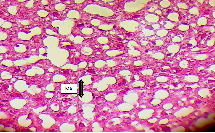 Figure 4: Cross histological section of liver tissue from castrated male mice showing lipid accumulation Macro vesicular steatosis (MA) (X400).