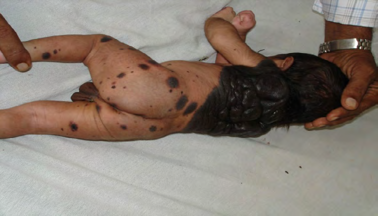 Figure 1: Pigmented convoluted patch over the back with giant melanocytic naevi over the buttocks and legs in a 2 day old infant.
