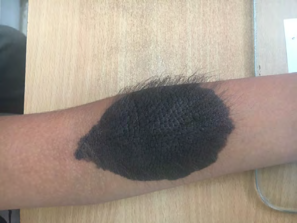 Figure 2: Hairy melanocytic nevus on a limb of 12 years old girl.