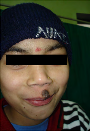Figure 3: Melanocytic naevi on face in a 11 years old girl.