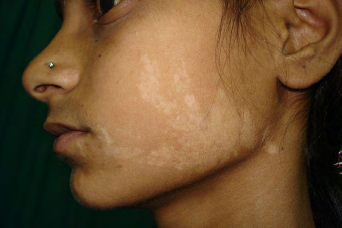 Figure 4: Nevus achromicus in a 11 years old girl.