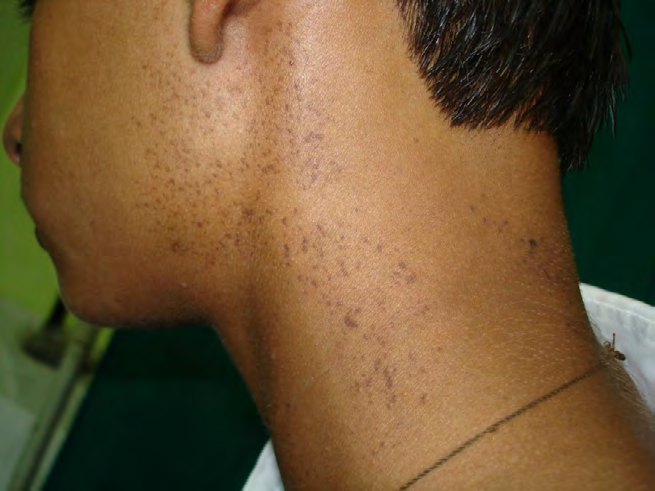 Figure 5: Verrucous epidermal naevus in a 14 years old male child.