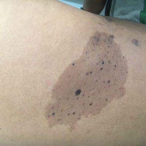 Figure 6: Non verrucous epidermal naevus in a 8 years old male child.