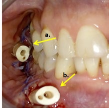 Figure 3: Silicone decompression valves with yellow arrows; a. Mandibular branch & b. Mandibular body.