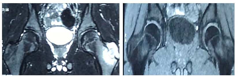 Figure 2: MRI of the hip showing a bone lesion in the left greater trochanter with T2 discreet hypersignal, well limited T1 hypersignal and regular contours, surrounded by a border with T1 and T2 hypointense without enhancement after injection of contrast. It measures 25mm x 23mm x 21mm and is accompanied by intraosseous edema in hypointense T1, Hypersignal T2, which is intensely and evenly enhanced after injection of contrast.