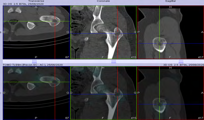 Figure 4: SPECT-CT examination focused on the left hip showing a lacunar osteolytic bone lesion of the left greater trochanter with a discreet bone hyperfixation.