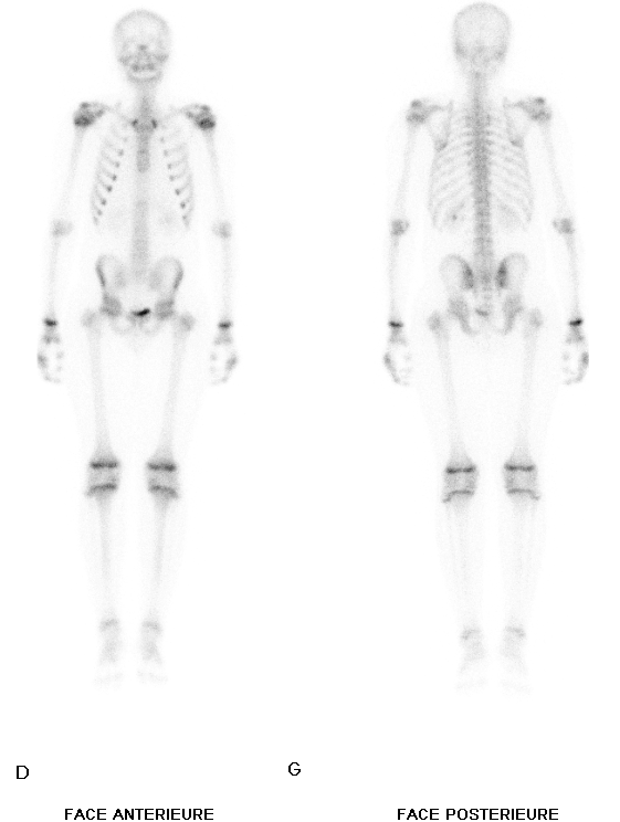 Figure 5: Whole body scan showing a single pathological bone hyperfixation opposite the left greater trochanter without any other pathological bone fixation clearly identifiable on the other parts of the skeleton.