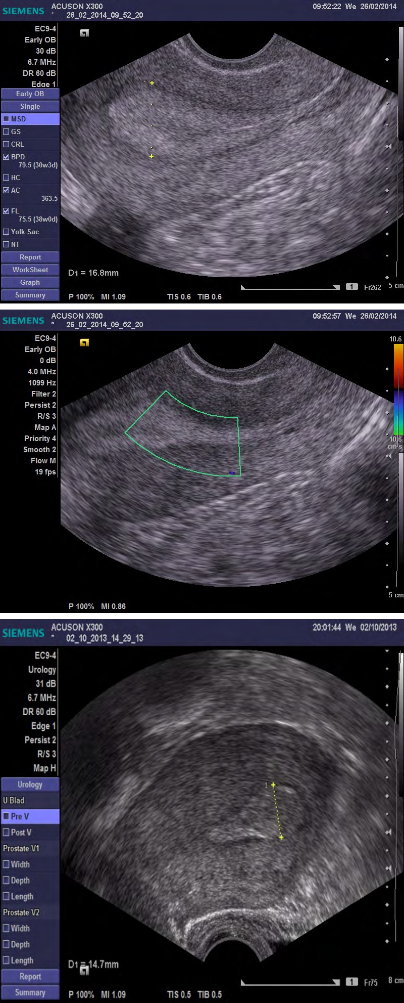 Figure 1: Endometrial thickness 16.5 mm, regular endometrial myometrial junction with linear midline, no detected blood flow (score 1), homogenous endometrium. Histopathology revealed endometrial hyperplasia.