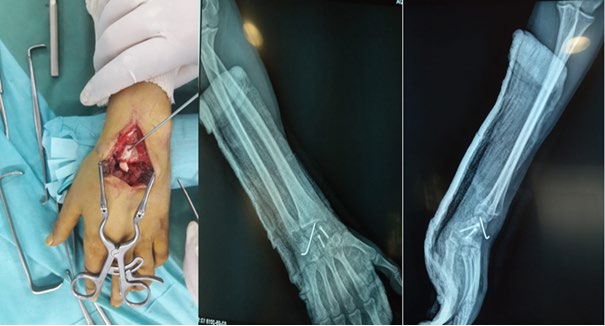 Figure 3: Surgery by dorsal approach / R * for immediate postoperative control.
