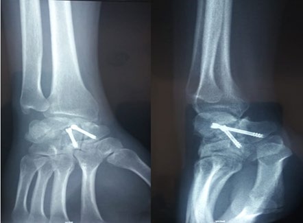Figure 5: Control radiographs 3 months after surgery.