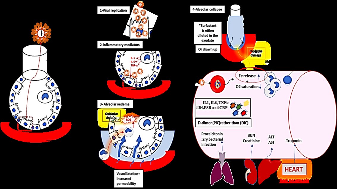 Figure 6: Pulmonary haemophagocytosis has been reported in COVID-19 with severe extensive alveolar and interstitial inflammation in the juxtaposed pulmonary vasculature. The diagram shows also the eventually O2 desaturation and release in the blood in addition to the powerful oxidative damage occurs in the lungs by the released iron. The associated cytokine storm, D-dimer, elevated liver and kidney functions were all illustrated in the figure.