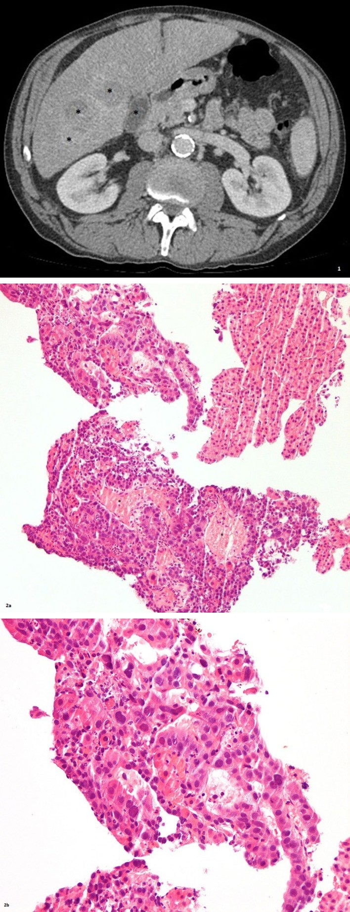 Figure 1: In order to establish a definitive diagnosis, an ultrasound guided needle core liver