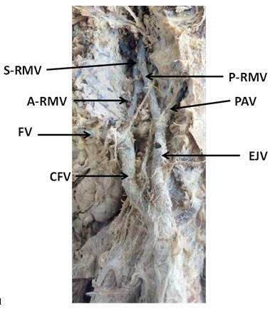 Figure 2: ** Magnified Left side of the head & neck showing a very short trunk of the retromandibular vein, which immediately divided into anterior and posterior divisions. The anterior division joined with the facial vein to form a common facial vein which directly drained into external jugular vein instead of internal jugular vein.