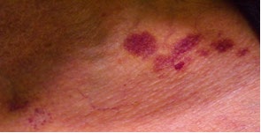 Figure 1: Periorbital subcutaneous hematomas.