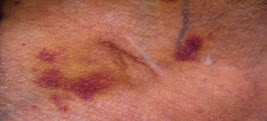 Figure 2: Thickening of the skin on the body and chest.