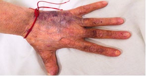 Figure 4: Subcutaneous hematomas.