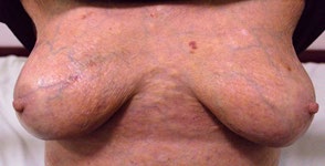 Figure 5: Subcutaneous hematomas.