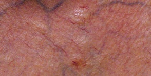 Figure 6: Dystrophic changes of the nails.