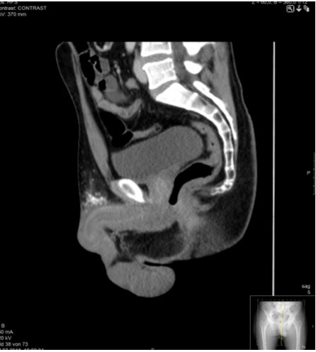 Figure 1: CT scan with contrast media, sagittal view showing diffuse swelling of the penile schaft without macroabscesses. Periglandular hyperdensities (arrow), probably calcified paraffin substrates.