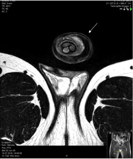 Figure 2: ** (a, b): T2 w TSE MRI sequence axial and sagittal showing diffuse swelling (arrow) of the penis. No obvious delineation of the abscesses. Testes appear normal on both sides. The calcified paraffin substrates appear as signal hypointensities (double arrow).