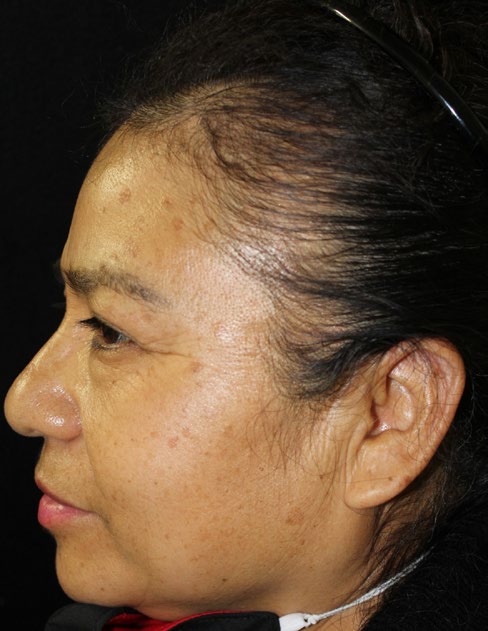Figure 1: Women of 44 years old with traction alopecia.