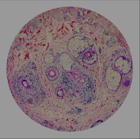 Figure 3: Preserved sebaceous glands and peripheral inflammatory infiltrate.