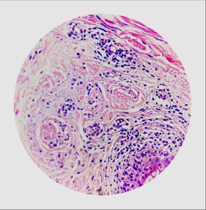 Figure 4: Peripheral inflammatory infiltrate and fibrous tracts. peripheral inflammatory infiltrate and fibrous tracts.