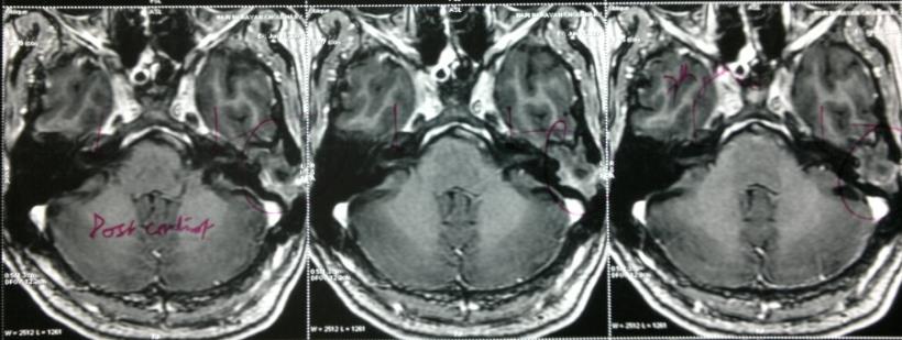 Figure 2: CT (a) and MRI scan (b) showing evidence of recurrent disease in the left ear.