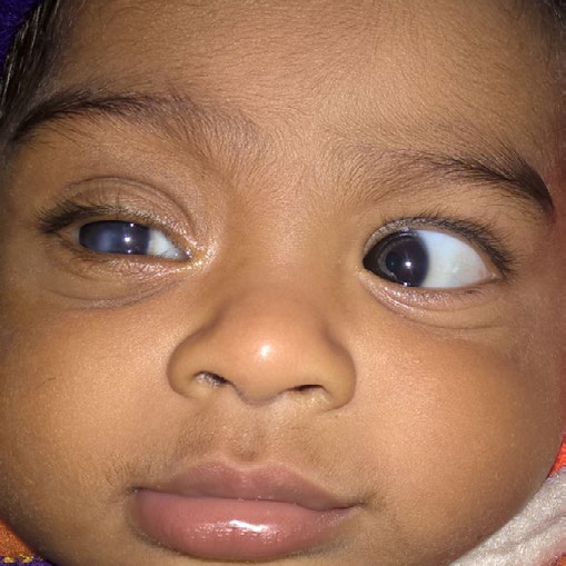Figure 1: Marked proptosis (Right side) with conjunctival chemosis, congestion and lustureless cornea.