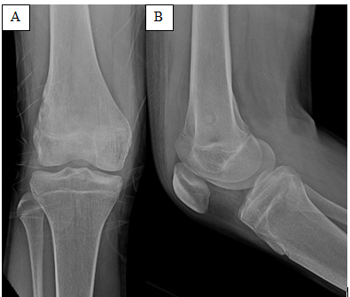 Figure 1: Right knee radiographs (Anteroposterior- A and Lateral-B views) revealed a well-defined, eccentrically located lytic lesion in the lateral cortical and subcortical region of meta-diaphysis of distal femur, showed central ossifications and significant surrounding sclerosis with ill- defined overlying cortex.