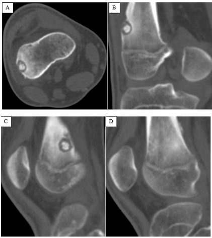 Figure 2: Axial (A), Coronal (B) and Sagittal (C,D) images of CT scan confirmed the mildly expansile lytic lesion with central matrix ossifications located in the cortical and subcortical region of meta-diaphysis of distal femur along its lateral cortex, causing focal cortical bulge and expansion with thinned out overlying cortex and cortical disruption at places (A,B). Note, the central ossification with significant thickening and sclerosis of adjacent cortex & medullary cavity (C) and benign looking periosteal reaction (D).