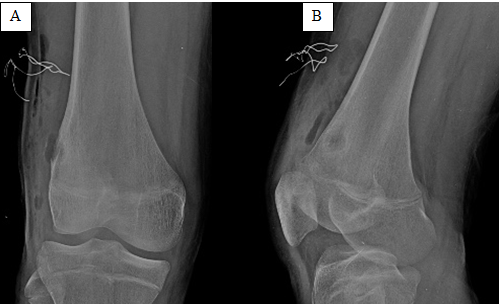 Figure 3: Post-operative radiographs of right knee (Anteroposterior – A and Lateral – B views) show post- operative changes.