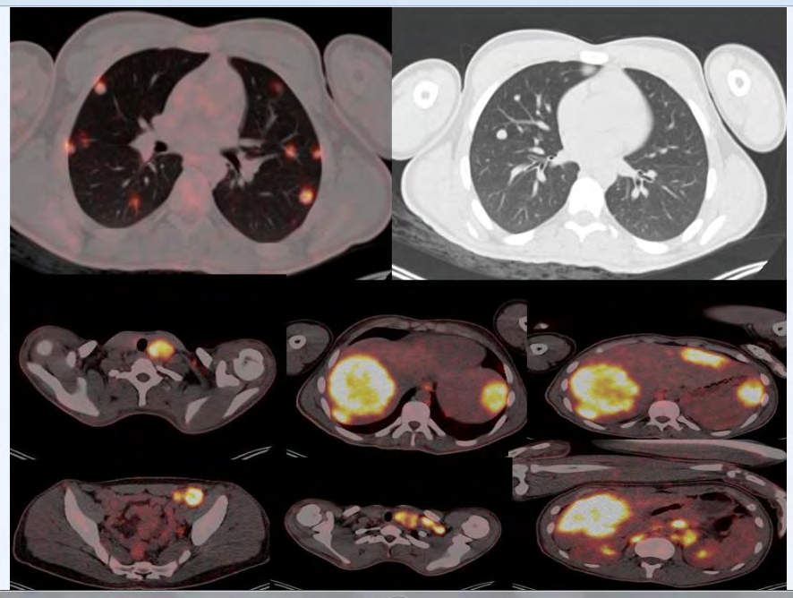 Figure 1: Axial PET-CT fusion and CT lung window images demonstrate lung metastases in top row. Metastatic lypmhadenopaties and liver metastases can be seen in the bottom figures.