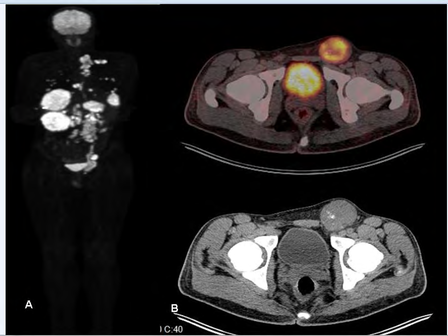 Figure 2: Maximum intensity projection (MIP) image (A) demonstrates all hypermetabolic focuses collectively. Axial PET-CT fusion and CT images shows primary left inguinal testis cancer mass (B).