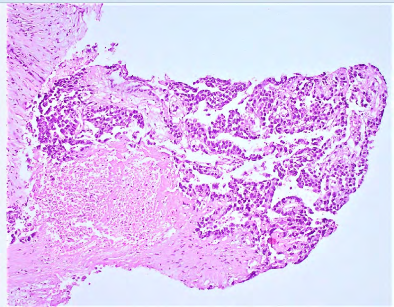 Figure 3: Tumoral cells with pleomorphic nuclei seen in glandular and solid patterrns with necrosis. (H&E X 100).