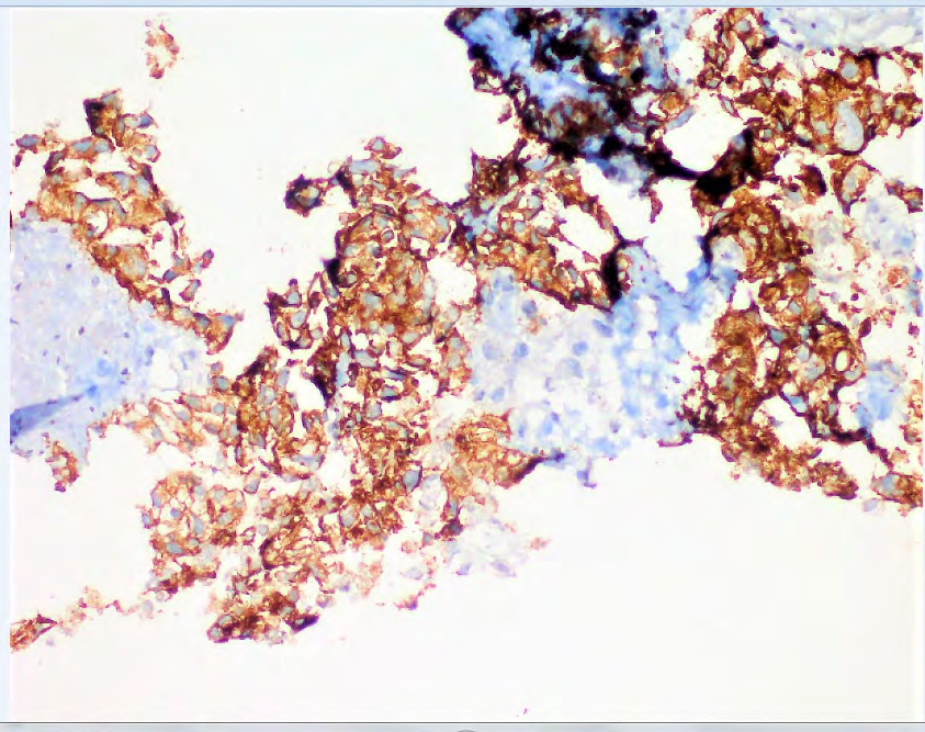 Figure 5: Tumoral cells with cytoplasmic and membranous staining with CD30 (X200).