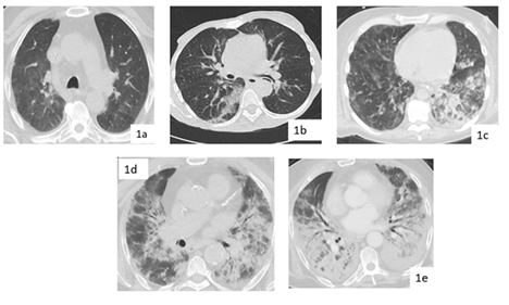 Figure 1: Chest CT imaging features for COVID-19 with different parenchymal severity SFR scores- 1a: Typical chest CT imaging features for COVID-19 with posterior, peripheral and rounded pure GGO in axial images of a haematological cancer patient (SFR score 1); 1b: Indeterminate CT imaging features for COVID-19. Unenhanced axial images showing patchy GGO with nonrounded morphology and no specific distribution, in a case of COVID-19 (score SFR 2); 1c: Typical chest CT imaging features for COVID-19 with pure bilateral mixed (peripheral and central) GGO with crazy paving and consolidation with air bronchogram of the left inferior lobe in a haematological cancer patient ( SFR score 3); 1d-1e: posterior and anterior, peripheral and central bilateral and multiple GGOs and patchy consolidations with air bronchograms; Organising pneumonia and influenza pneumonia can be indistinguishable from COVID-19 (SFR scores 4 and 5 respectively).