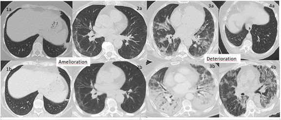 Figure 2: Two patients with radiological amelioration (1a-1b and 2a-2b) and two patients with radiological deterioration (3a- 3b and 4a-4b) between the initial chest CT and the follow-up 1. All patients were symptomatic with positive RT-PCR SARS-COV -2 on admission.