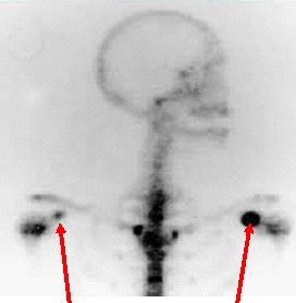 Figure 2: A nuclear medicine bone scan showing intense uptake at the coracoid process bilaterally consistent with active enthesopathy.