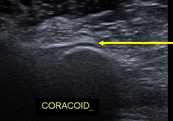 Figure 3: An ultrasound directly over a painful coracoid process showing the hypoechoic change of enthesopathy directly adjacent to the bony process.
