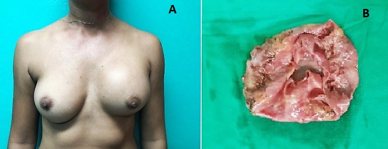 Figure 1: A. Patient with grade III CC according to Baker’s classification in the left breast. B. Capsule removed during surgery after 8 years of implant placement, periareolarly and retromuscularly.
