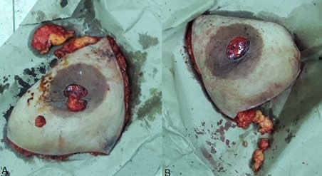 Figure 3: Resected breast tissue. A: Right breast. B: Left breast.
